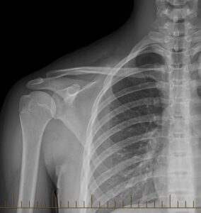 Shoulder x-ray.